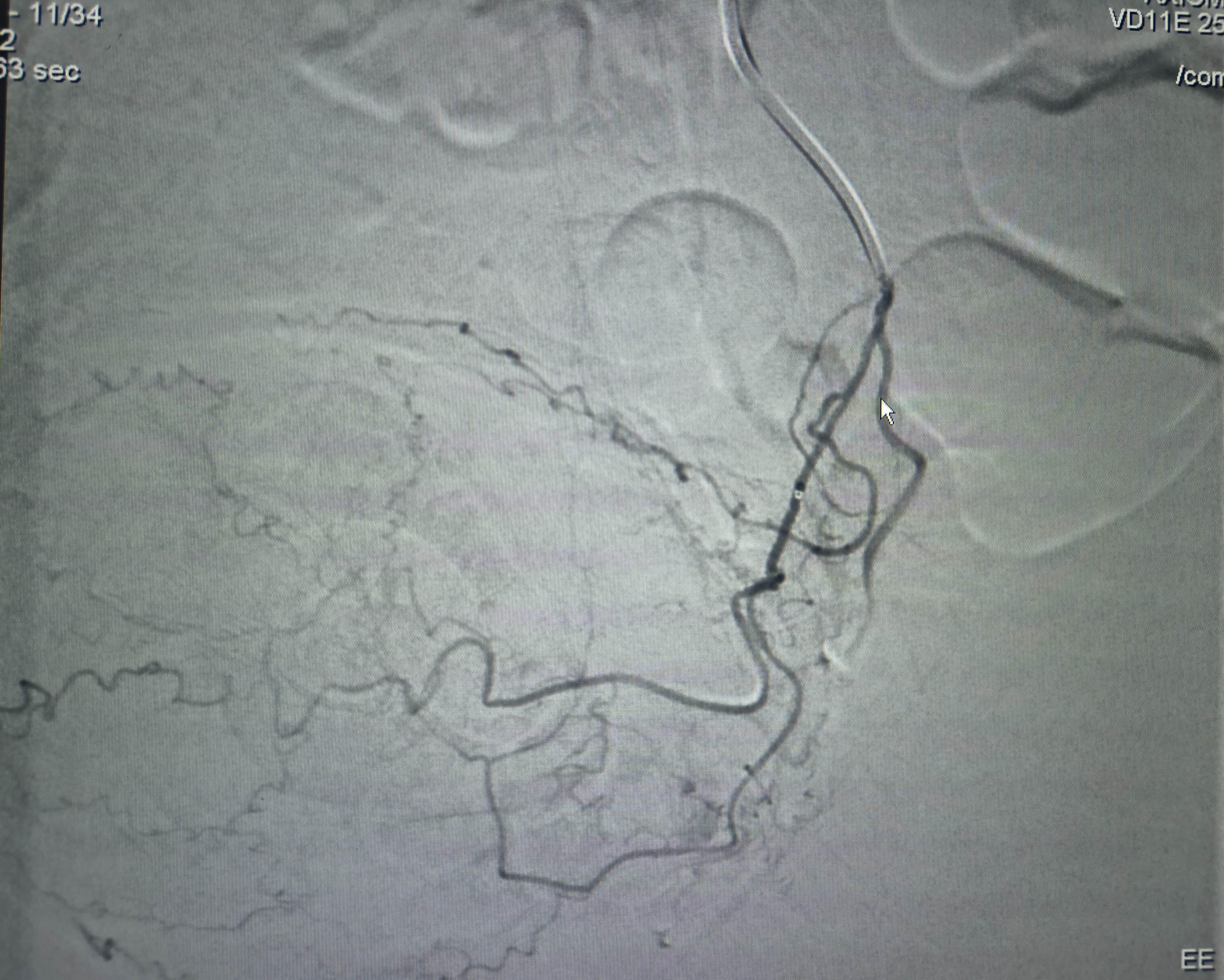 Left Prostatic Artery from the Left Superior Vesical Artery